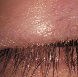 Blepharitis