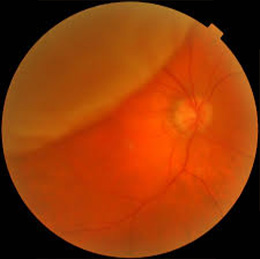 Retinal Detachment 