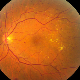 Diabetic retinopathy